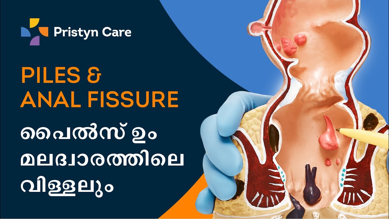 Piles, Anal Fissure Treatment in Malayalam | Pristyn Care | For Free appointment call: 9220708788