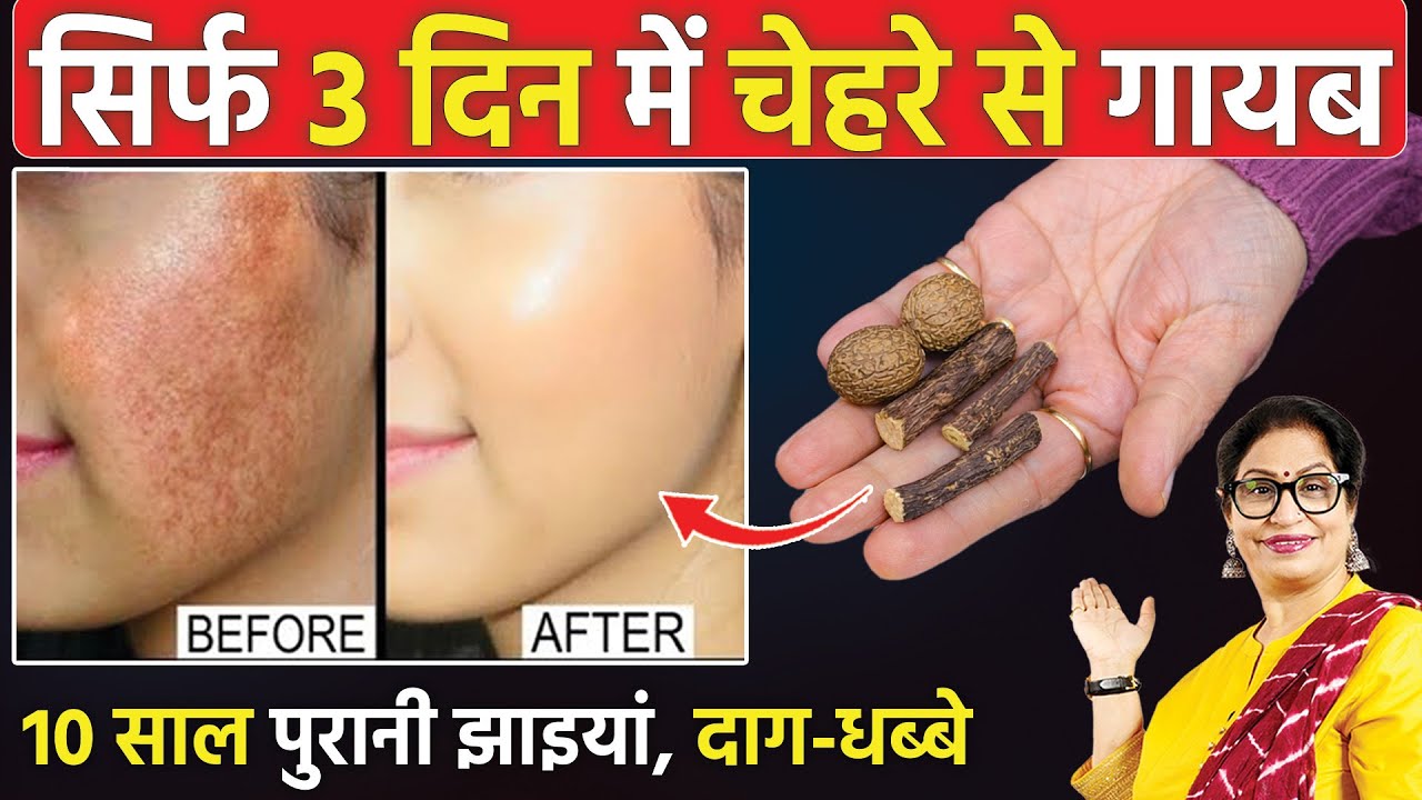 सिर्फ 7 दिन में कितनी भी पुरानी झाइयां, काले दाग धब्बे से 100% छुटकारा पाएं | Nutmeg Cream For Face