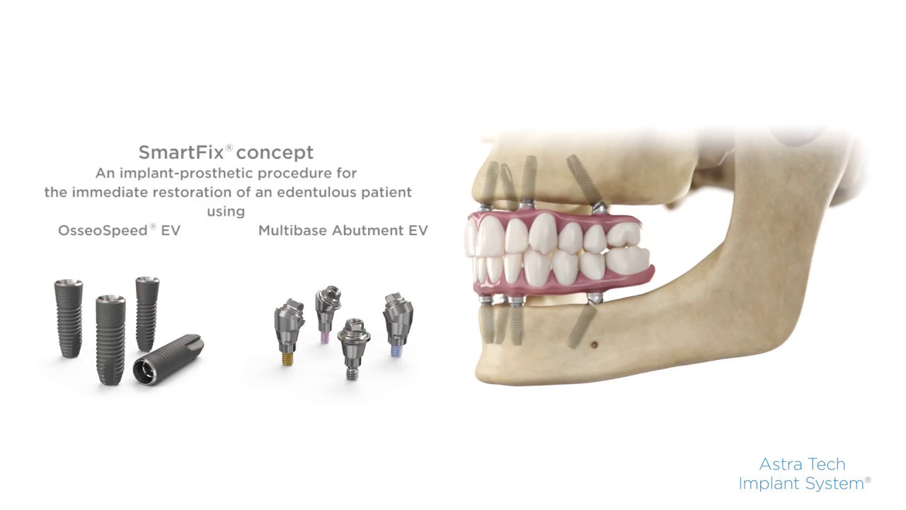 Step-by-step procedure: SmartFix® concept  for Astra Tech Implant System® EV | Dentsply Sirona