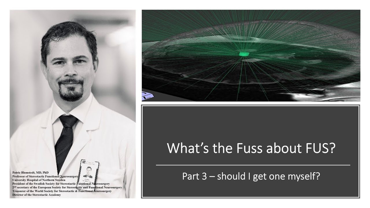 What's the fuss about FUS - Part 3: Should I get one?