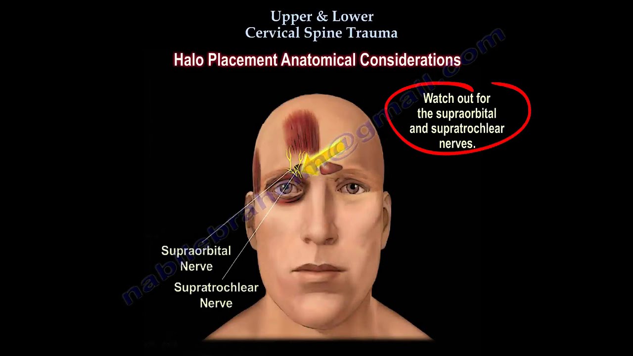 Upper & Lower cervical Spine Trauma, neck injury    Everything You Need To Know - Dr. Nabil Ebraheim