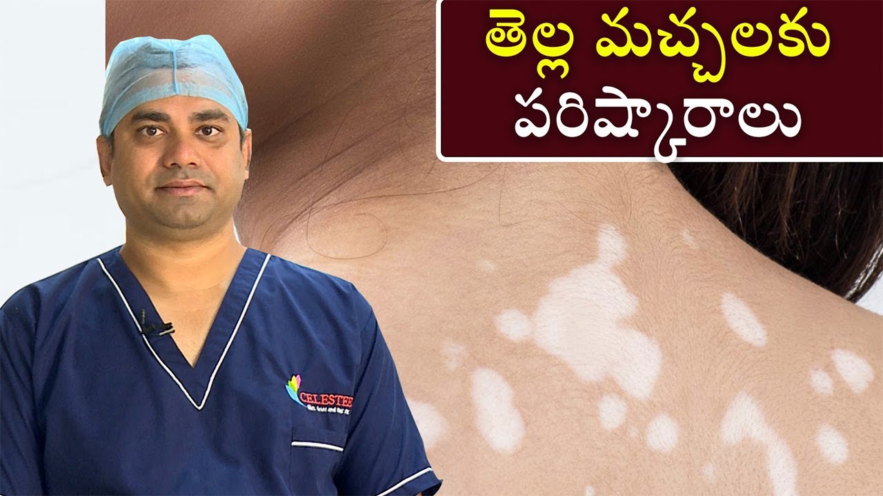 White Patches On Skin | తెల్ల మచ్చలకు పరిష్కారాలు