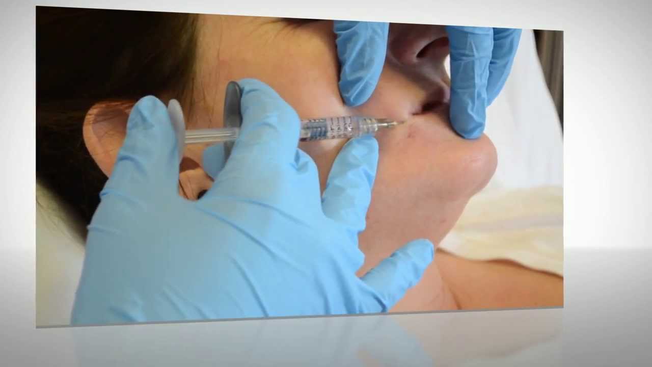 How to treat marionette lines.. Before and after dermal filler