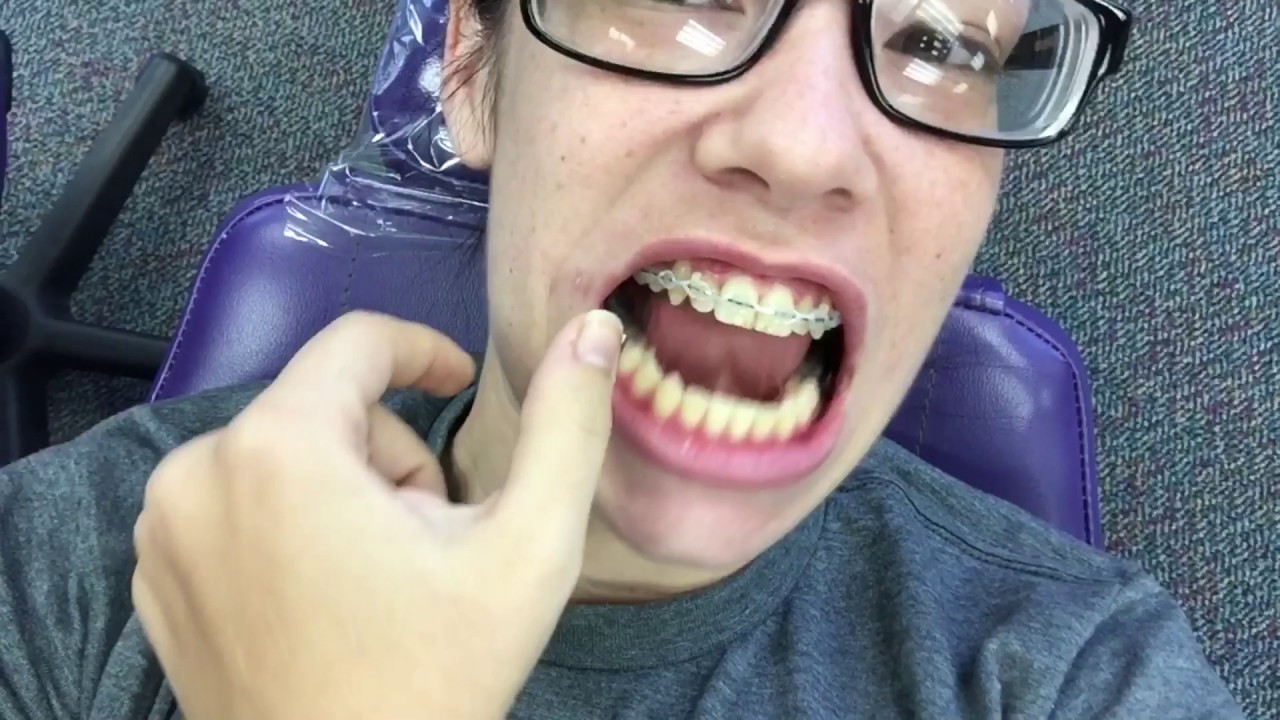 Adult Braces - Getting Bottom Braces