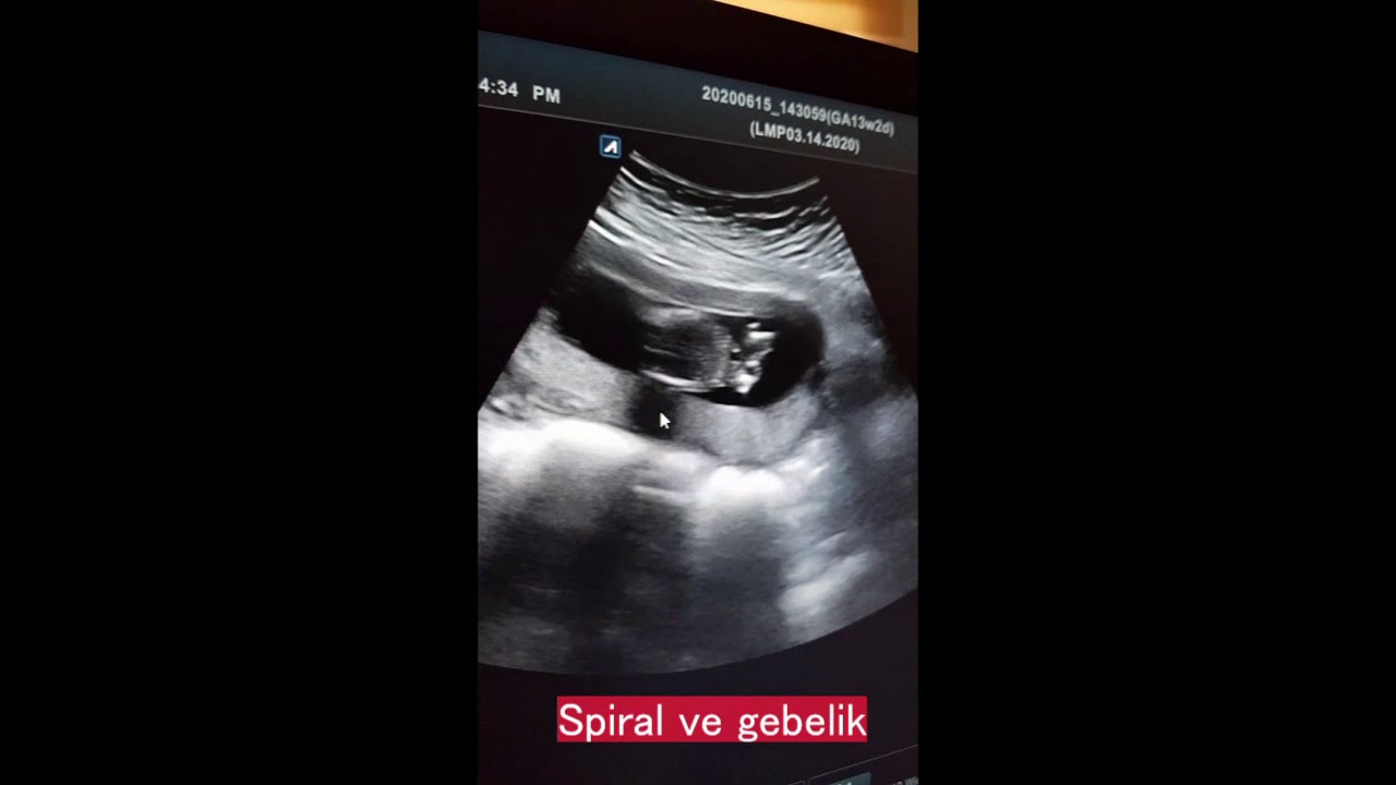 Spiral (RİA- Rahim i&ccedil;i ara&ccedil;) kullanırken gebe kalmak m&uuml;mk&uuml;n m&uuml;?
