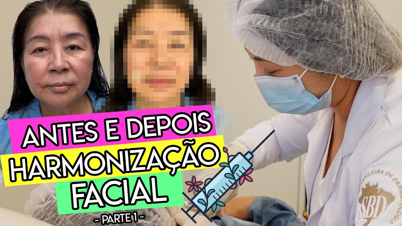 COMO FICOU A HARMONIZAÇÃO FACIAL NA MINHA MÃE ✨ PELE MADURA ✨com a Dra Mamy Honda🎉
