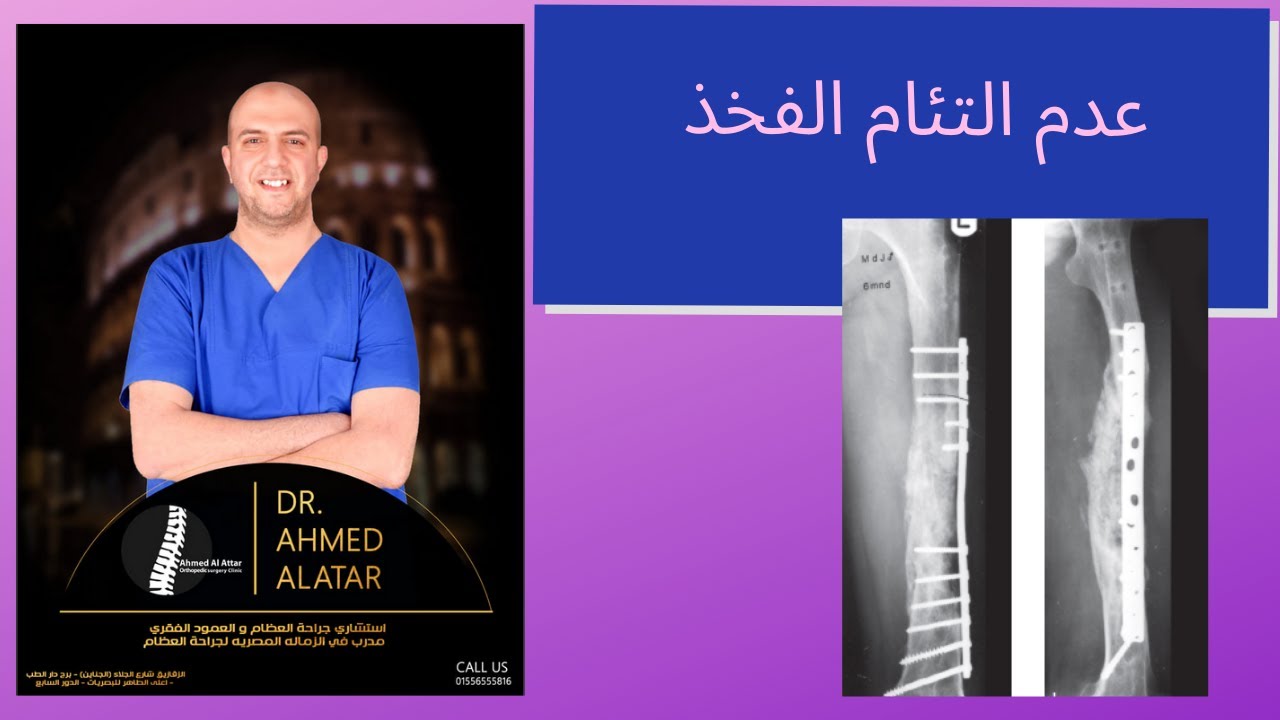 عدم التئام الفخذ - طريقة التفكير في الموضوع