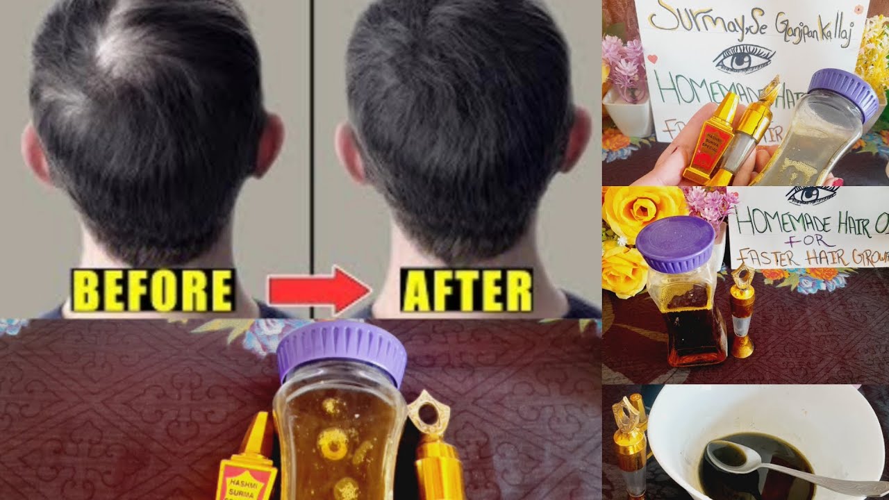 Ganjpan Ka Desi llaj  | Surmay Se Ganjpan Ka llaj  ||  Homemade Hair Oil For Faster Hair Growth  |