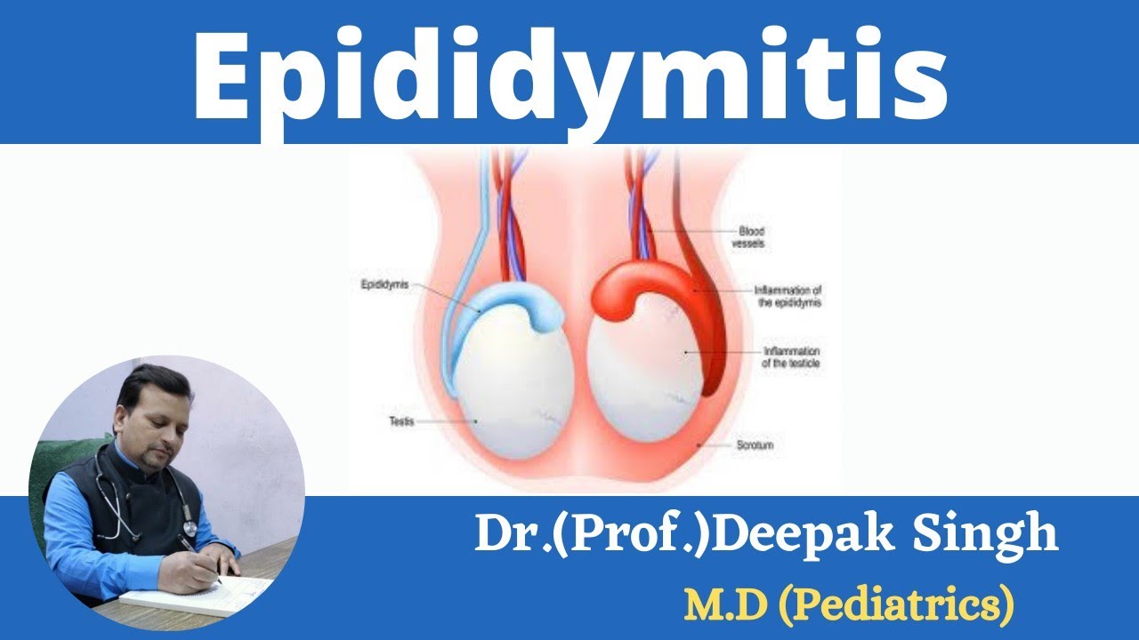 Epididymitis # Inflammation in epididymis # Deepak PD. Singh