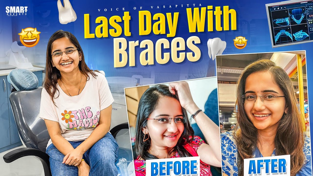 Last day with braces | Vasapitta Braces journey telugu #voiceofvassapitta #teluguvlogs 