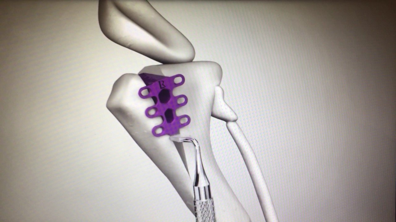 TTA Rapid Surgery for ACL injuries in dogs