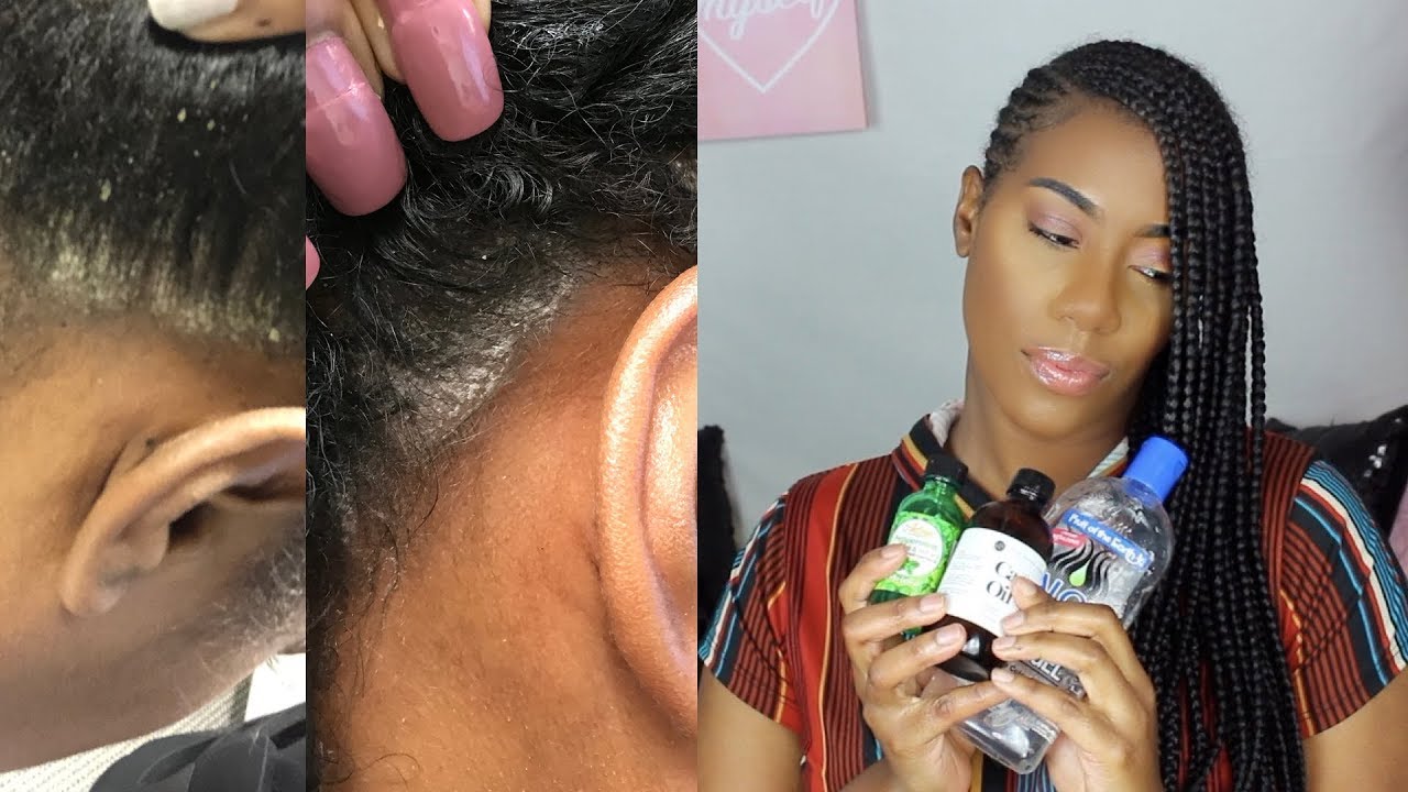 Update: How I control my seborrheic dermatitis, flakes,eczema,& psoriasis? How did I know ?