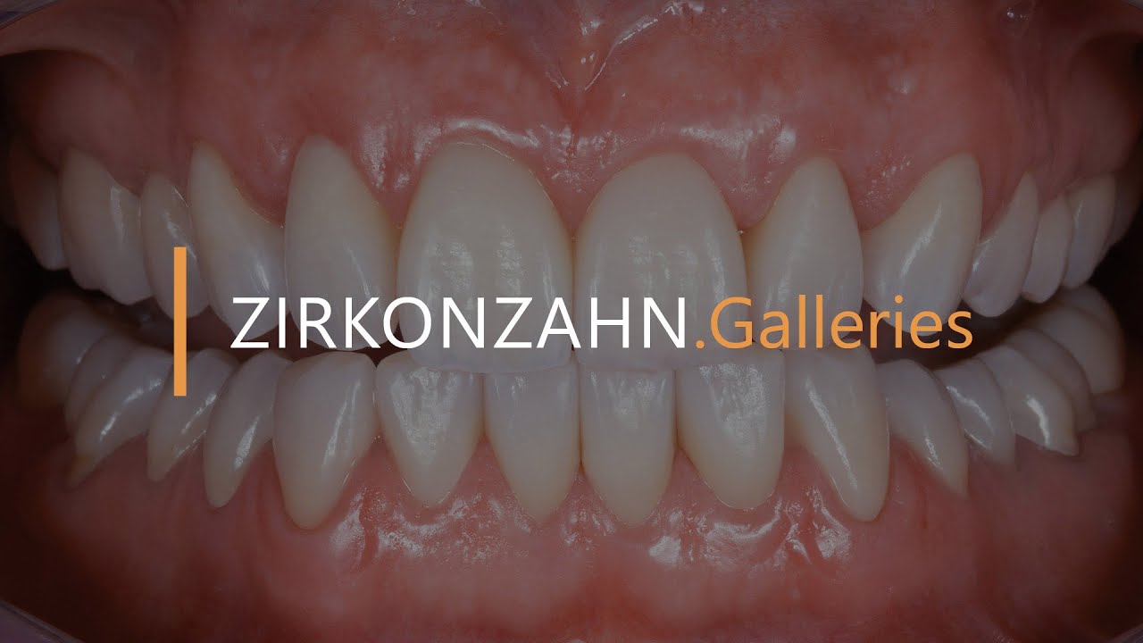 Prettau® 3 Dispersive® – Optimal function thanks to additional steps | Zirkonzahn.Galleries