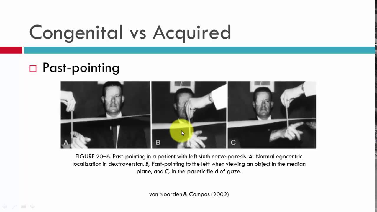 Differential Diagnosis in Incomitant Strabismus