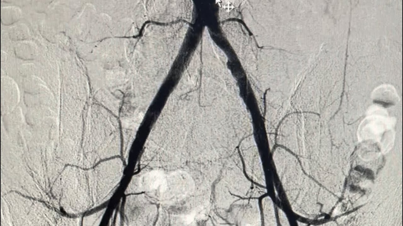 Angiographische Darstellung einer pAVK