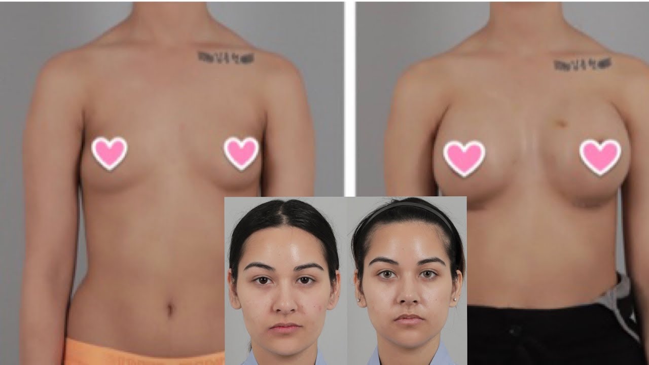 Patient Q&A Breast, Nose and Facial Contouring Surgery | Seoul Guide Medical