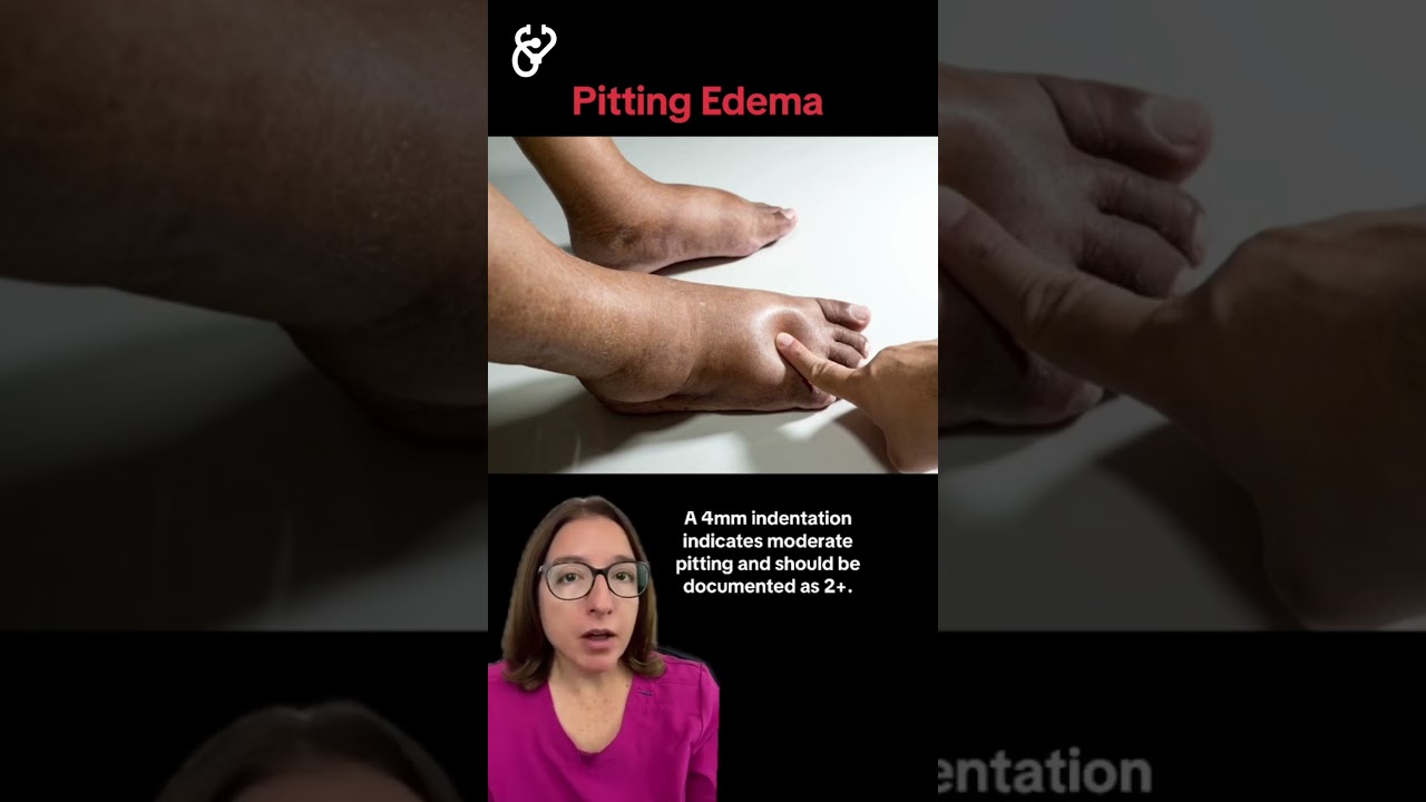 Pitting Edema: Health Assessment SHORT | 
