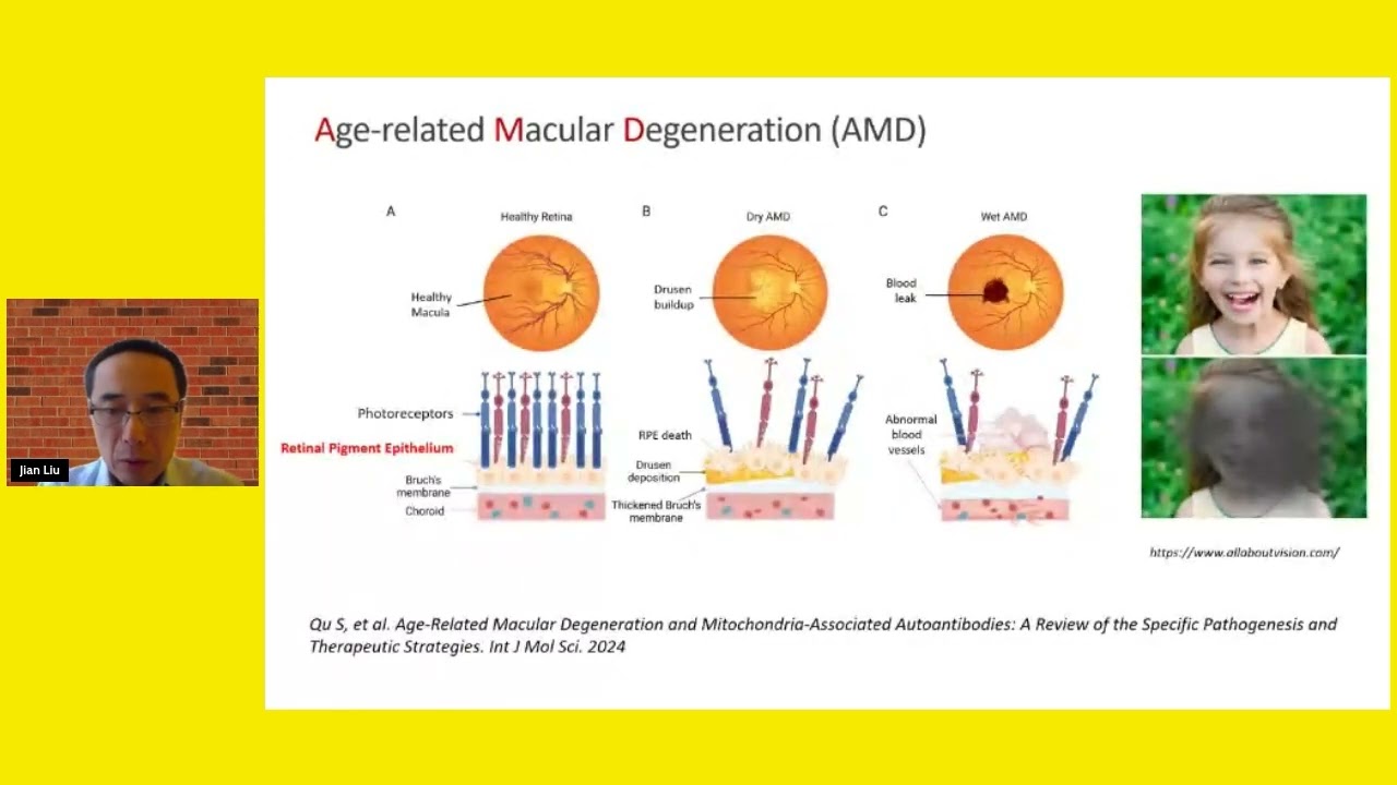 Cellular senescence and emerging senotherapies for macular degeneration with Dr Jian Liu