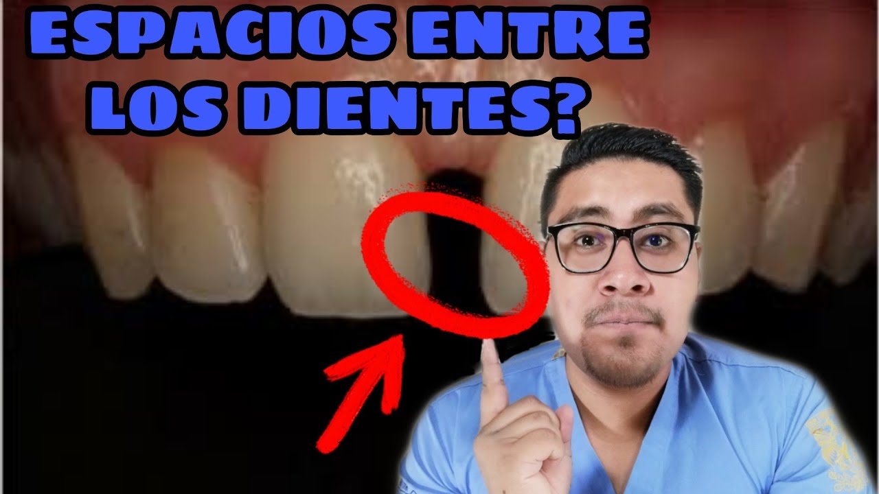TIENES ESPACIOS ENTRE LOS DIENTES?- COMO TRATAR UN DIASTEMA