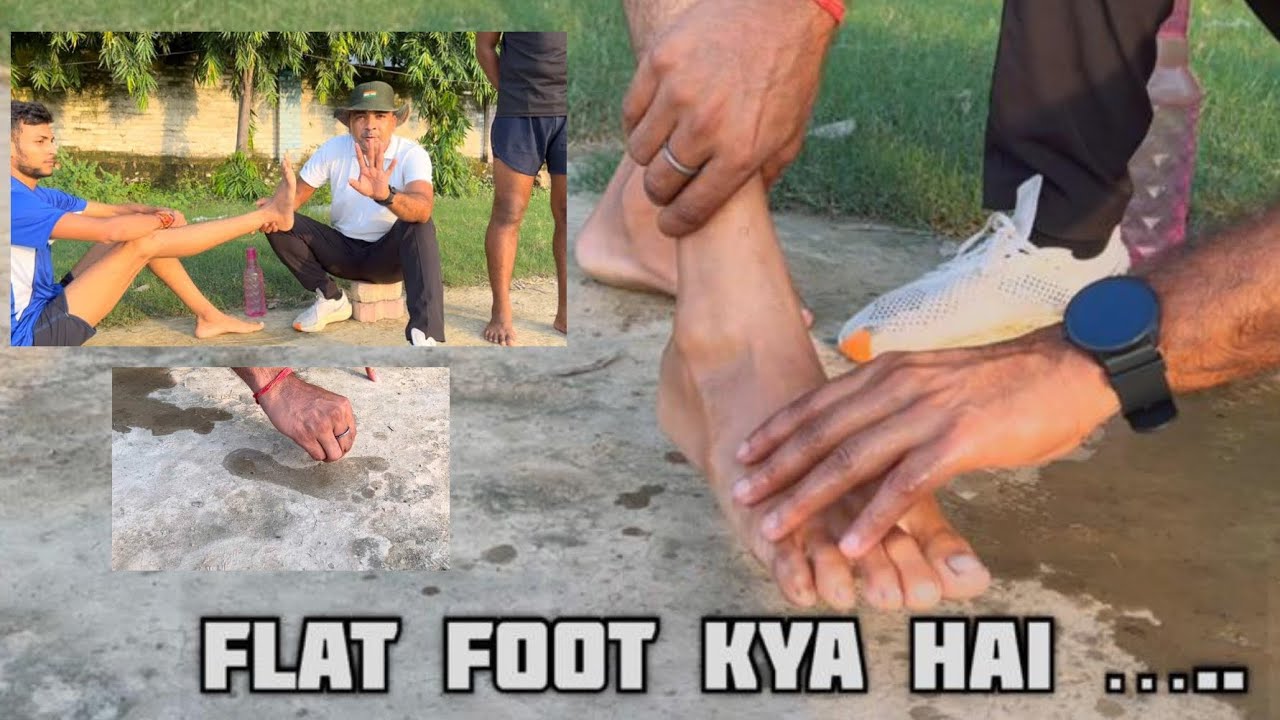 What is Flat Foot{Flat Foot Kya Hai}Medical Test Flat Foot 2023 101% Problem Solve |Defence Medical