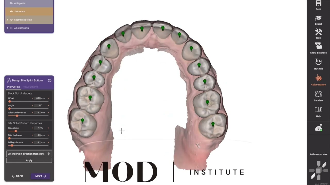 exocad AI assisted bite splint design