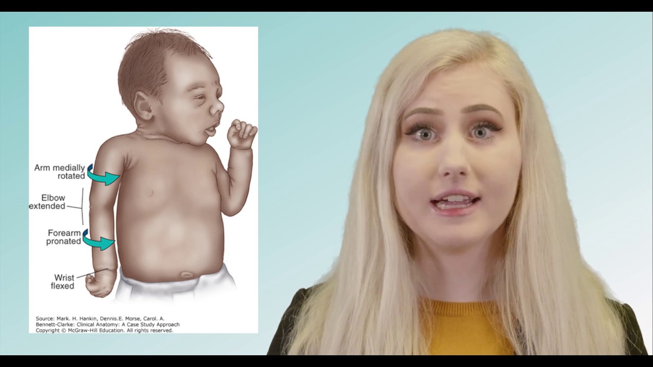 Erb's Palsy