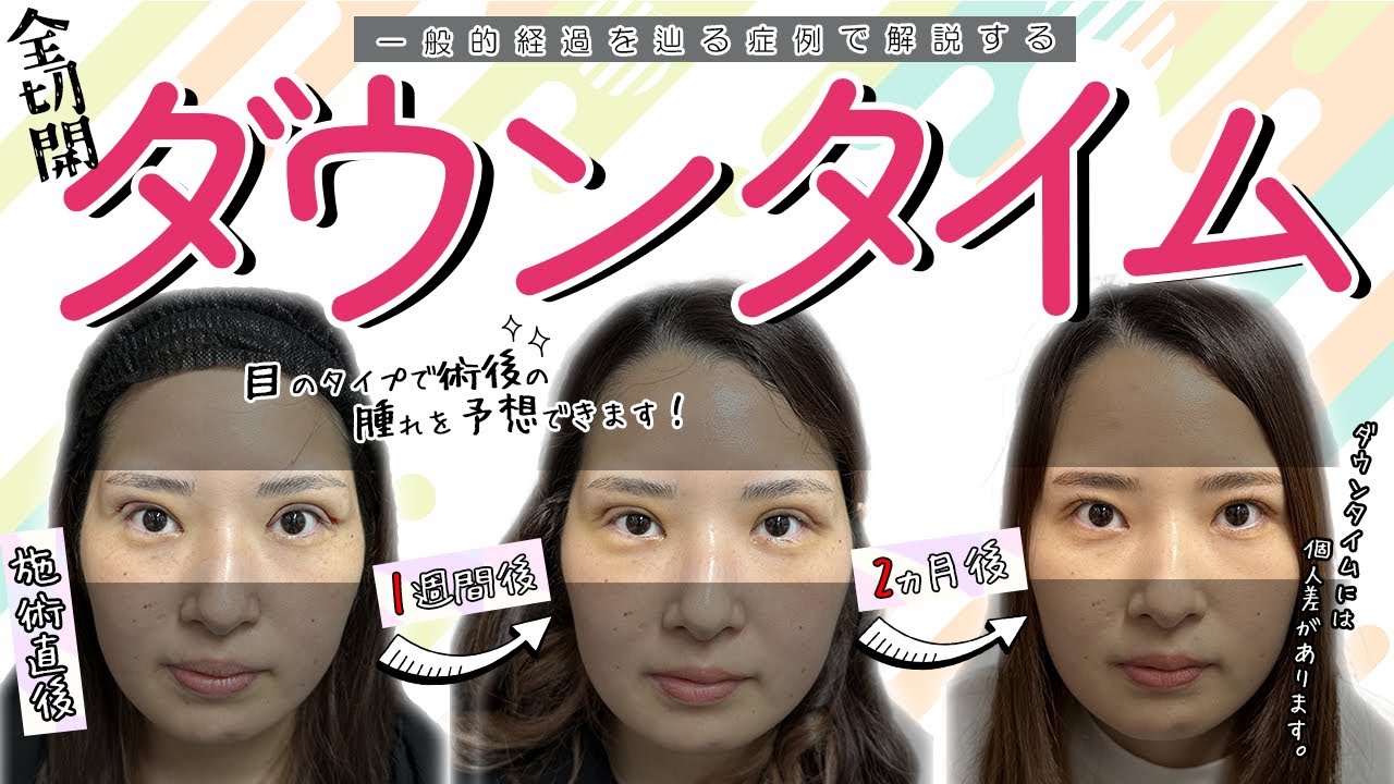 【保存版】二重切開の一般的なダウンタイムの経過を解説