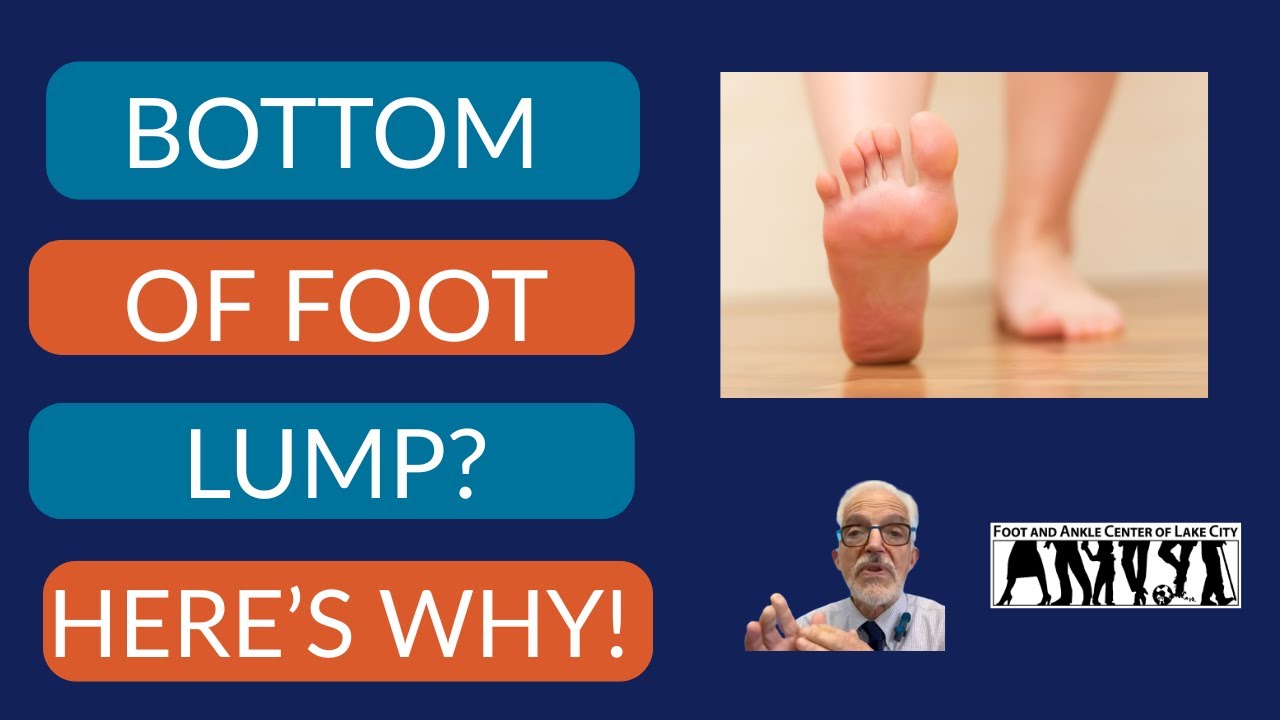 8 Reasons for that Lump On the Bottom of Your Foot