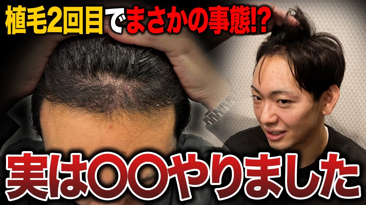【違和感】2回目の植毛から4ヶ月経過！新たな事態が発覚!?