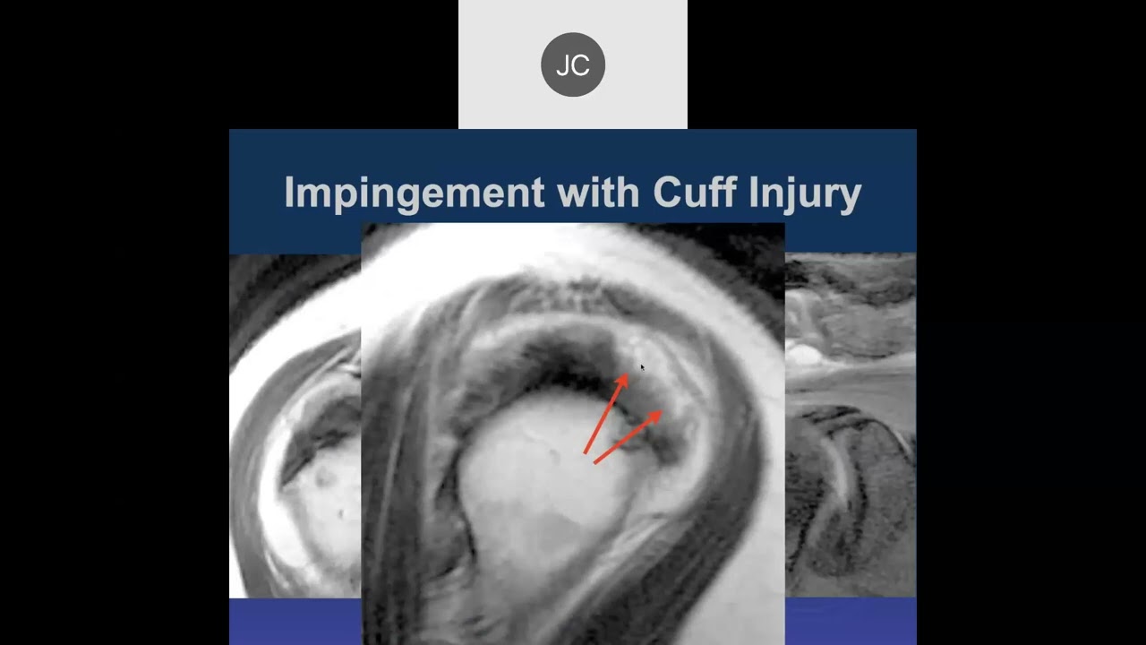 MR of Shoulder Impingement 2023