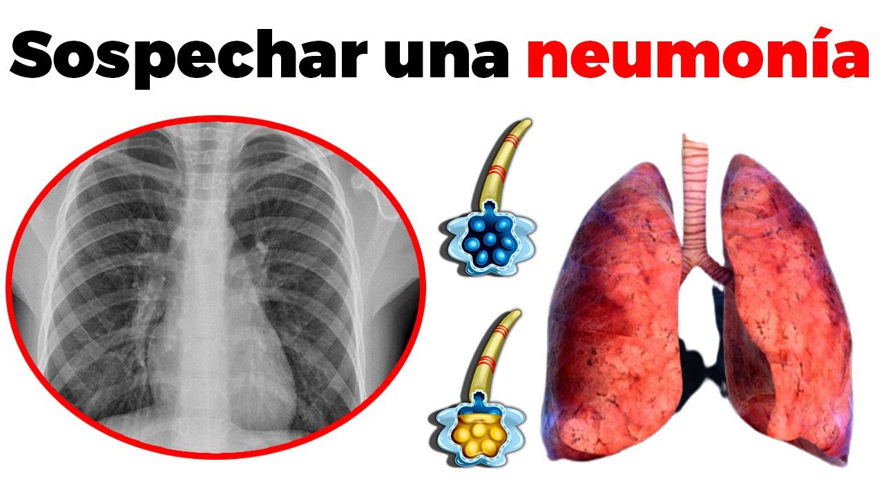 Síntomas de NEUMONÍA: cómo se diagnostica y tratamiento
