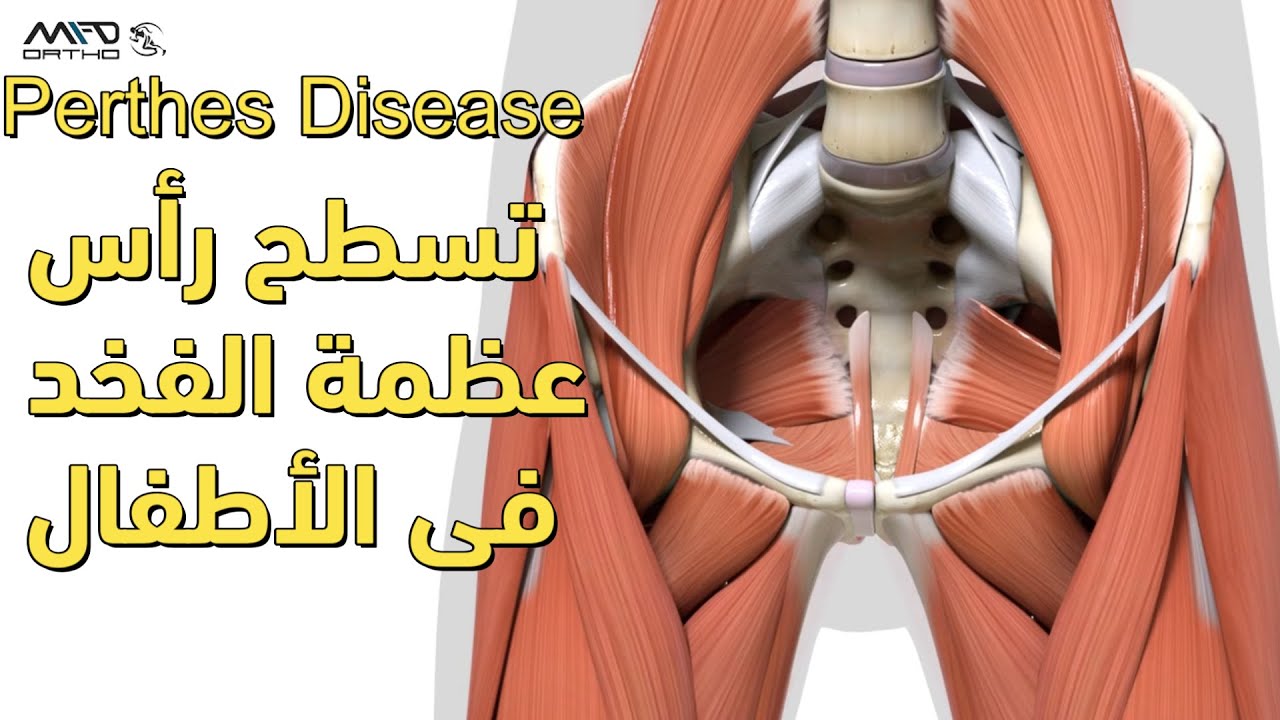 تآكل رأس عظمة الفخذ فى الأطفال ( Perthes Disease )