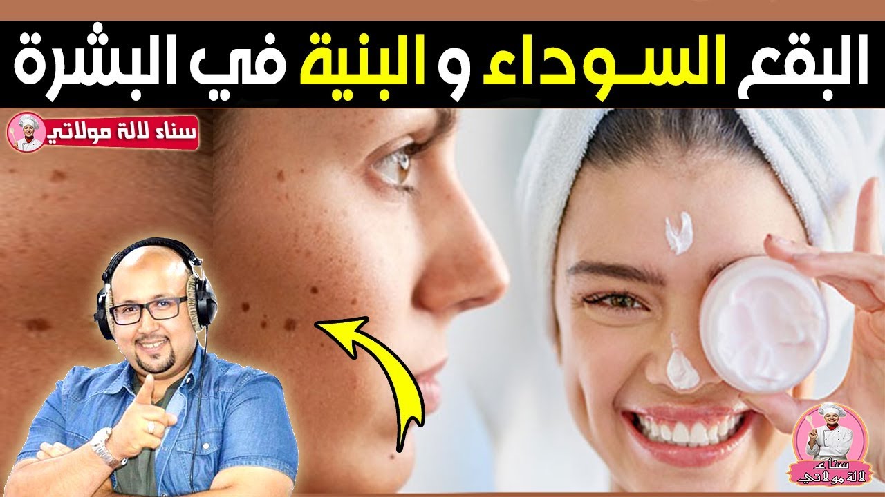 أسباب ظهور البقع السوداء والبنية في البشرة وطرق العلاج بوصفات طبيعية مع الدكتور عماد ميزاب