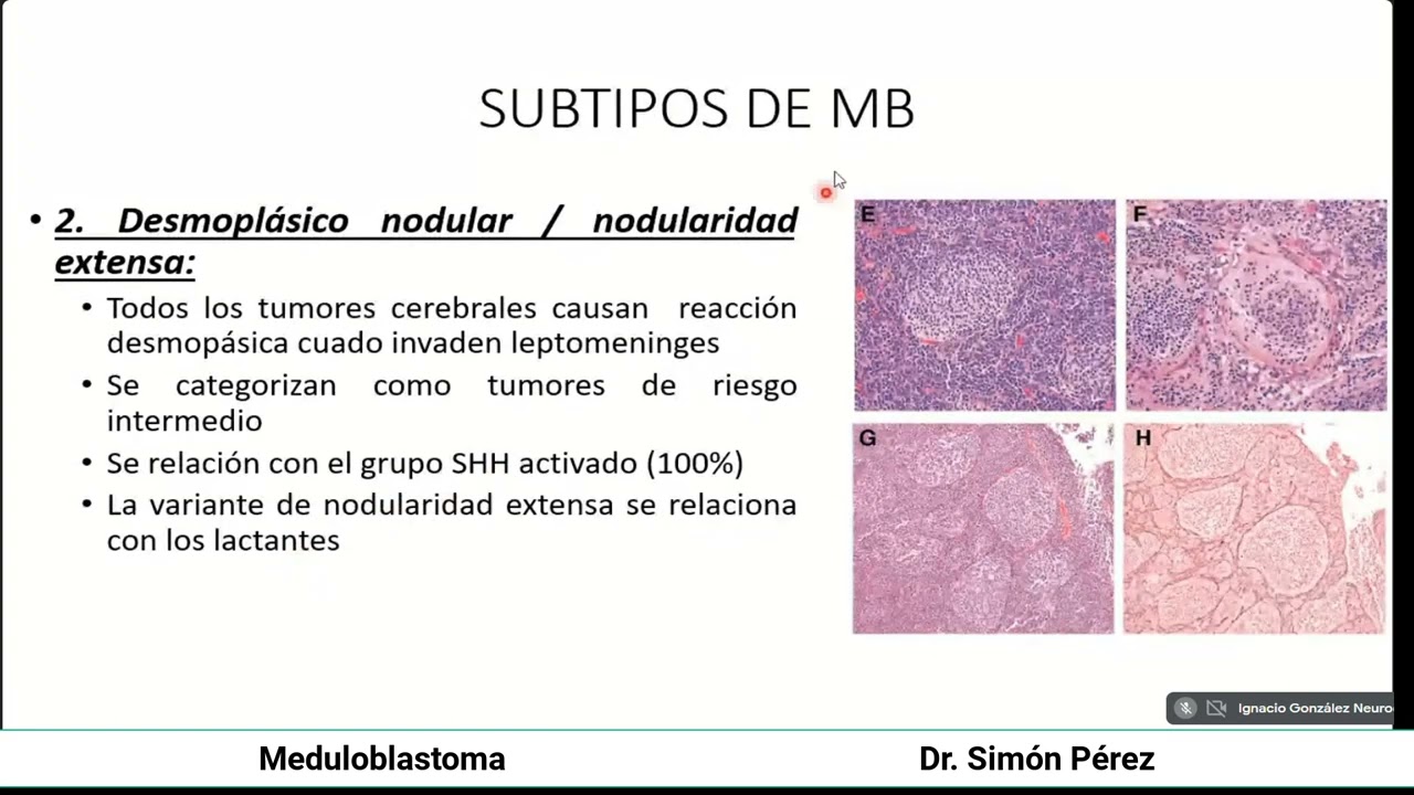 Meduloblastoma
