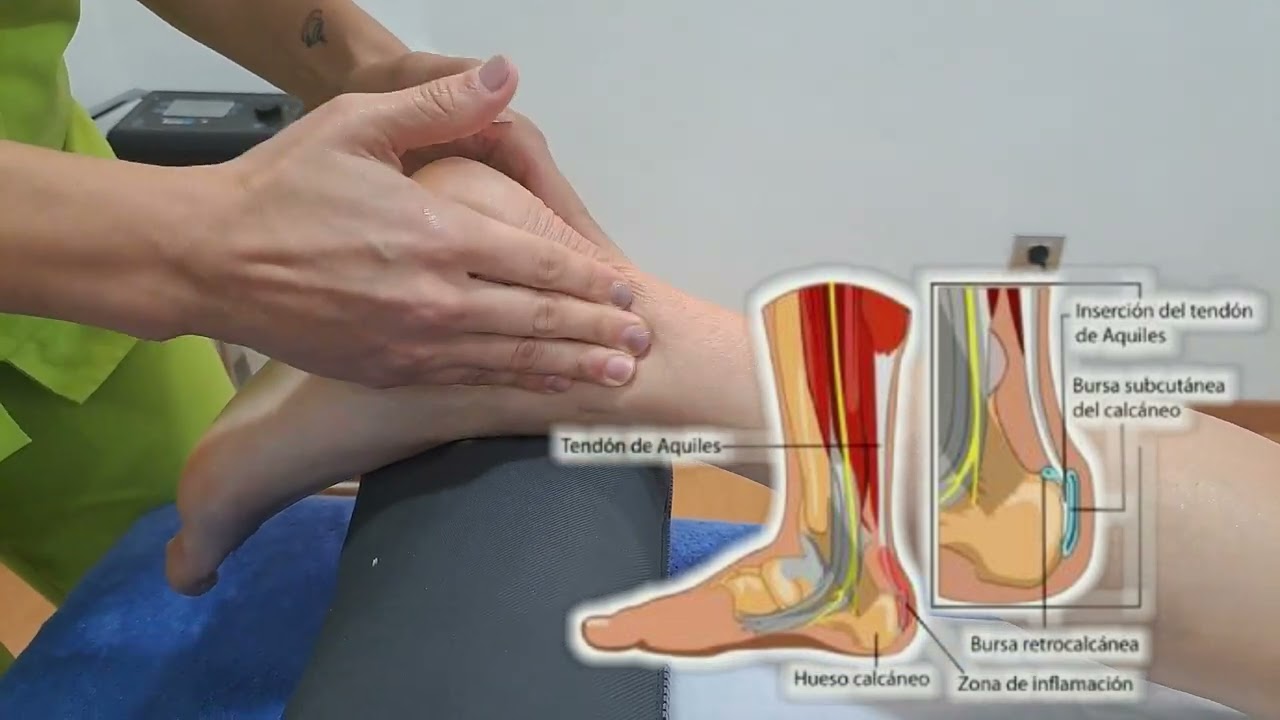 💯 DOLOR TENDÓN DE AQUILES/tratamiento para la inflamación TENDÓN AQUILES 🦵MASAJE PASO A PASO .