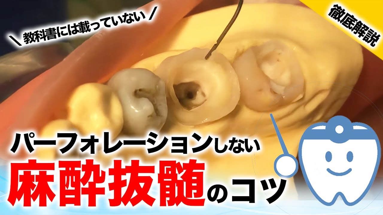 【歯科医師必見】パーフォレーションしない麻酔抜髄のコツを徹底解説！［教科書には載っていない歯科技術］