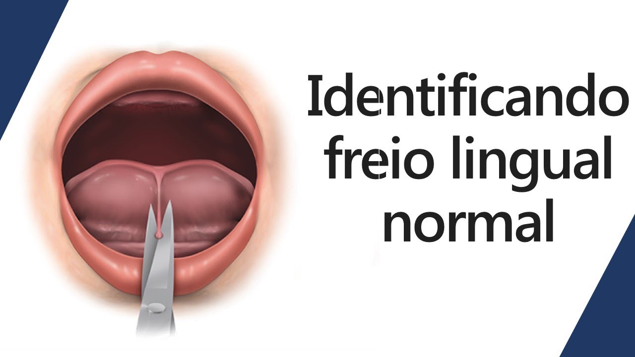 Identificando freio lingual normal | Odontologia | Dra Bianca Rosa
