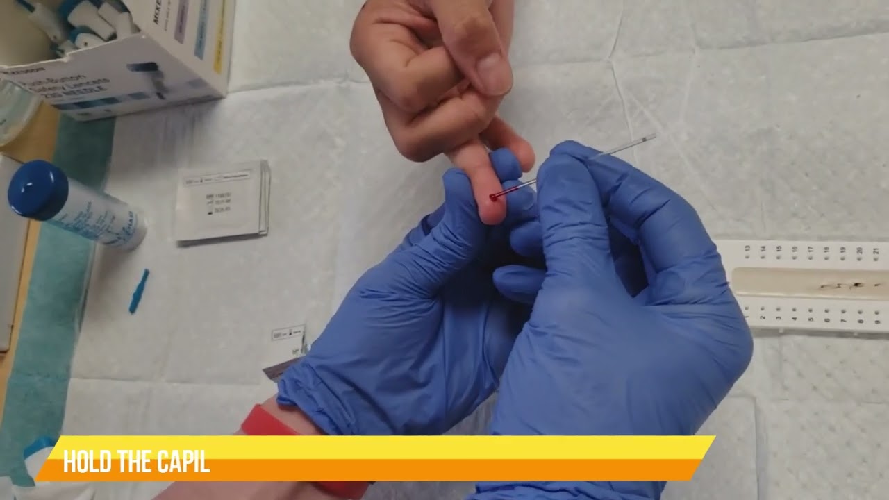 SKIN PUNCTURE AND COLLECTING BLOOD SAMPLE USING A CAPILLARY TUBE