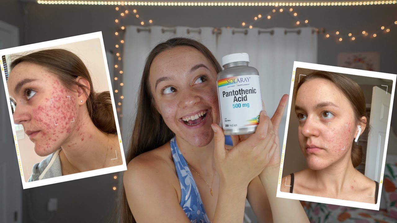 I TOOK PANTOTHENIC ACID FOR 2 MONTHS | Pantothenic Acid (B5) For Acne