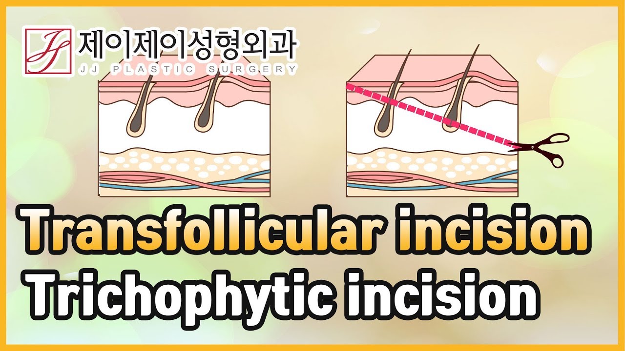 Transfollicular incision,Trichophytic incision