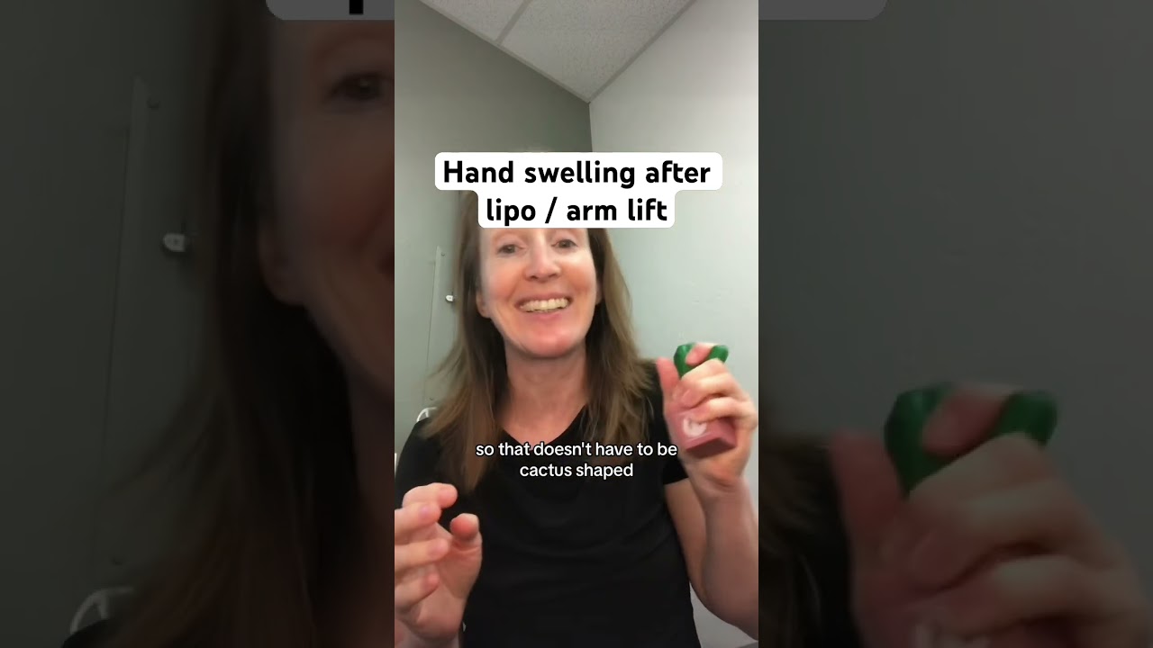 Reduce hand swelling after #armliposuction #liposuction #plasticsurgery