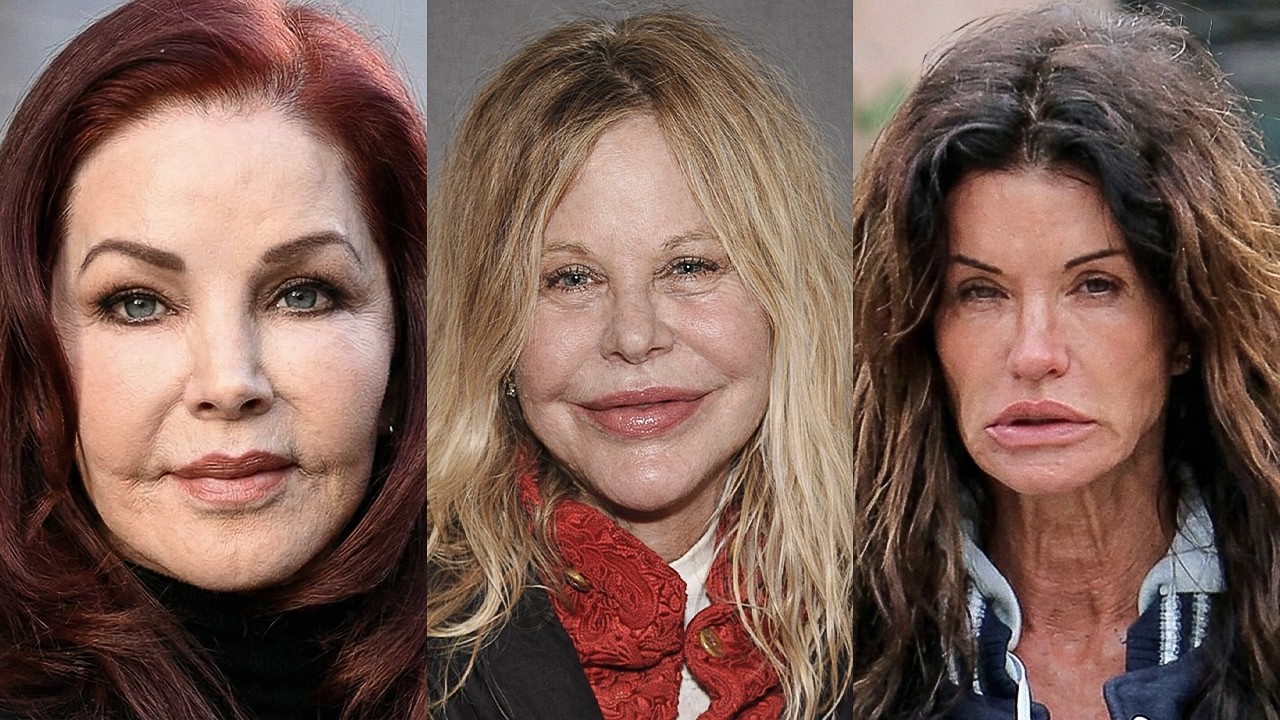 15 Classic Beauties Suffering From Pillow Face | Before and After Photos