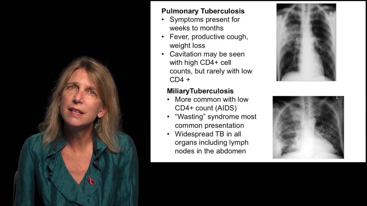 HIV Symptoms by D Havlir, University of California San Francisco
