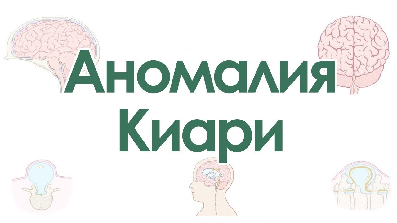 Аномалия (Мальформация) Киари