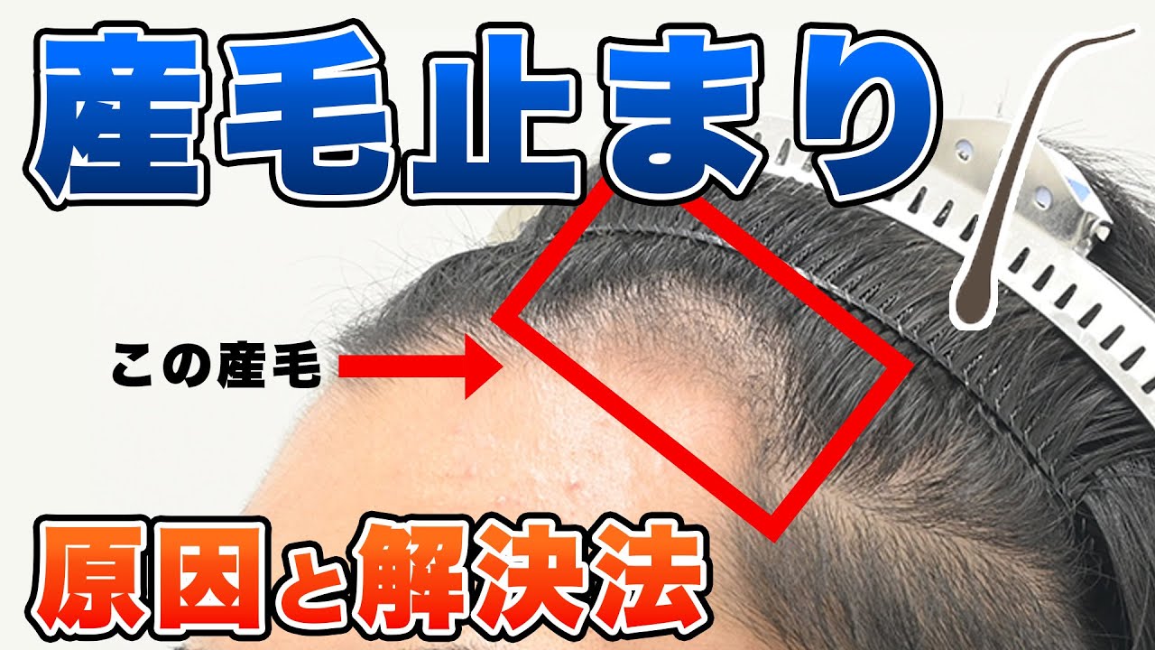 AGA治療薬を飲んでもM字が産毛止まり。生えない理由と解決方法！