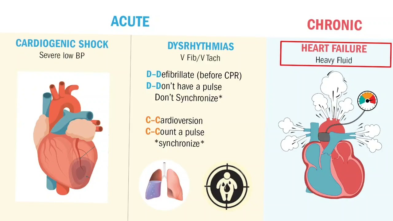 Myocardial Infarction Complications - Heart Failure & Ventricular Tachycardia