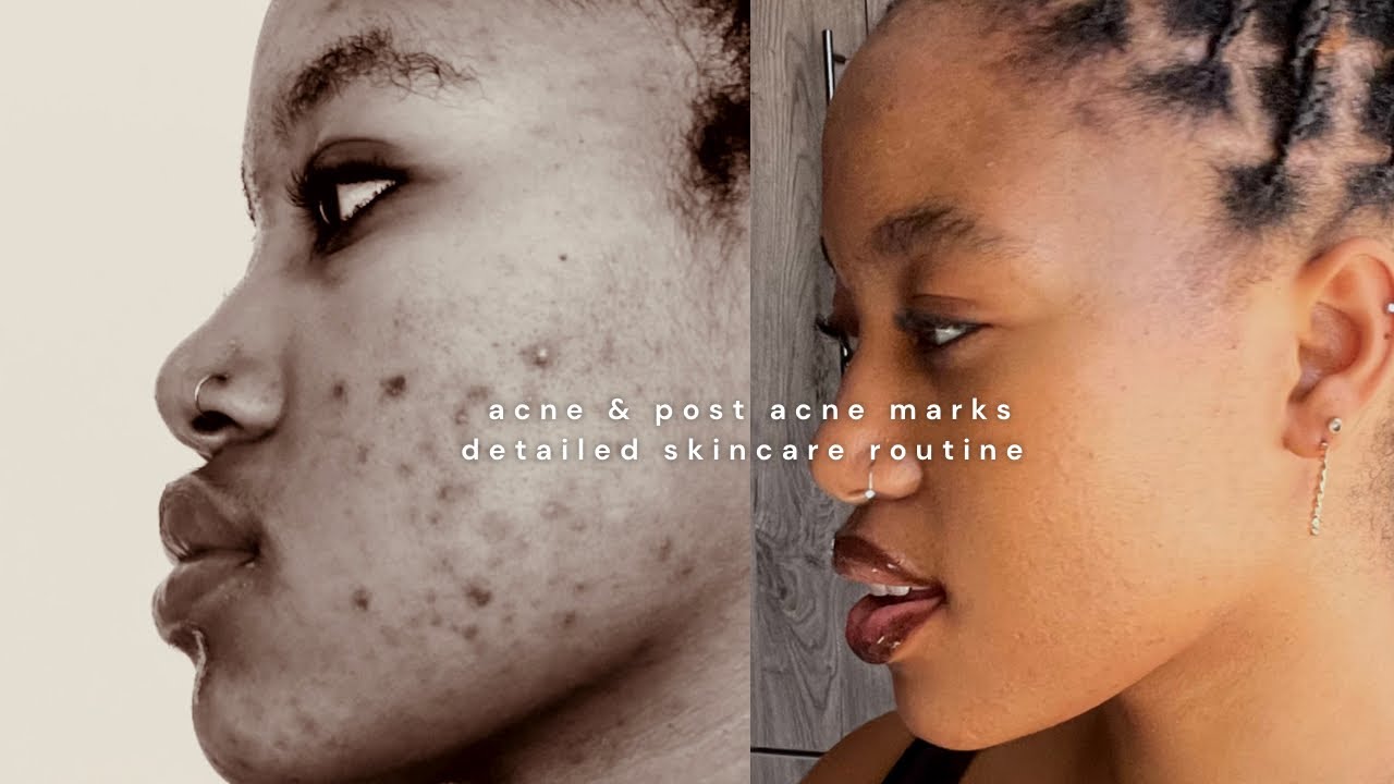 my detailed skincare routine for acne and dark spots