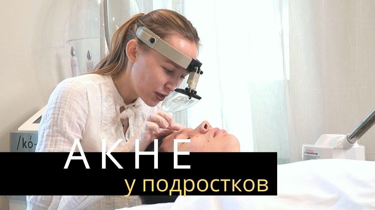 АКНЕ. Прыщи у подростков | Лечение Акне у косметолога | Anastasia Talan