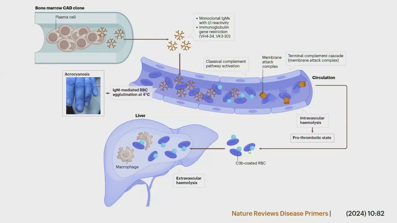 Webinaire AIH : Anémie hémolytique auto-immune