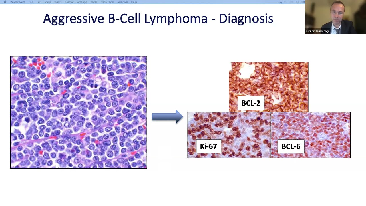 New Biological Insights and Novel Strategies in Aggressive B-cell Lymphoma